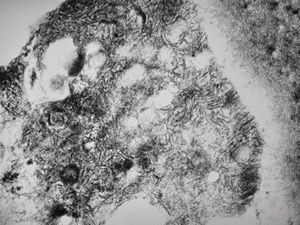 F,25y. | metachromatic leukodystrophy - n.suralis